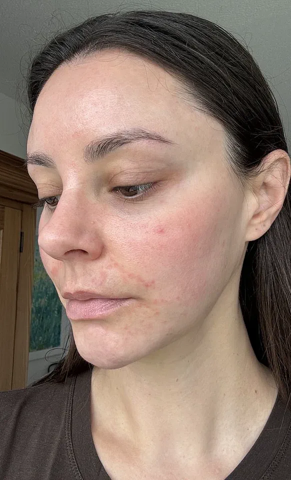 Late-Breaking: Emma North's Warning at OneWelbeck Clinic – The Perils of Perfection in Beauty