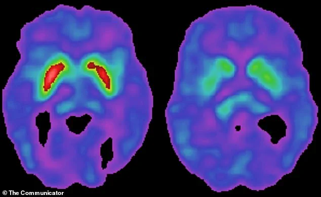 Breakthrough Discovery Links Common Virus to Parkinson’s Disease, Reshaping Understanding of Neurological Condition