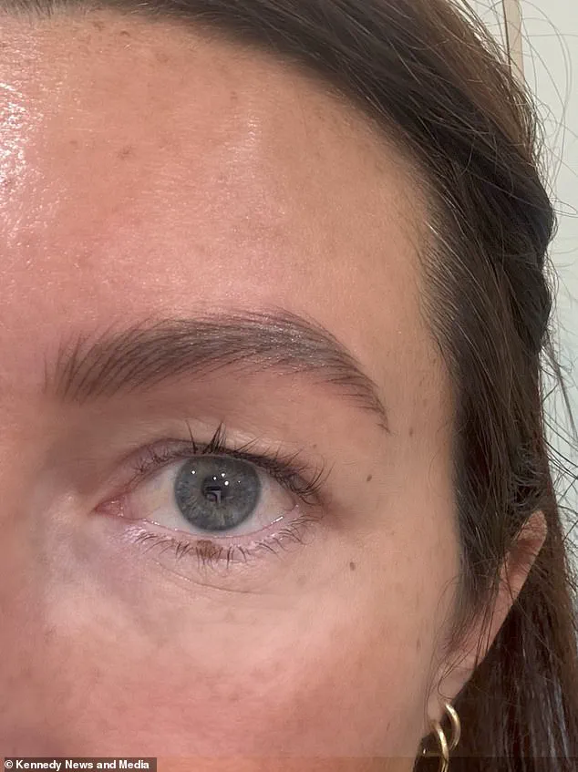 From Exhaustion to Confidence: Sophie Watkins' Transformative Eyelid Surgery Journey