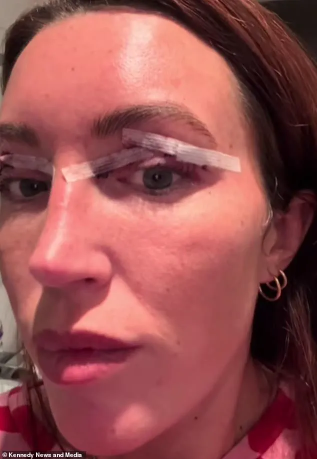 From Exhaustion to Confidence: Sophie Watkins' Transformative Eyelid Surgery Journey