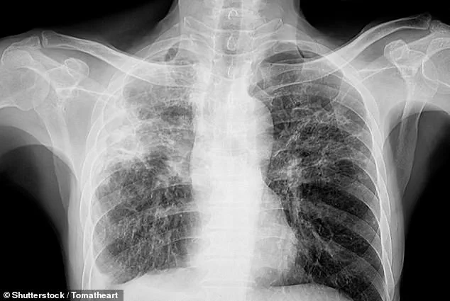 Silent Threat of Vision Loss Linked to Pulmonary Fibrosis, Warn UK Experts