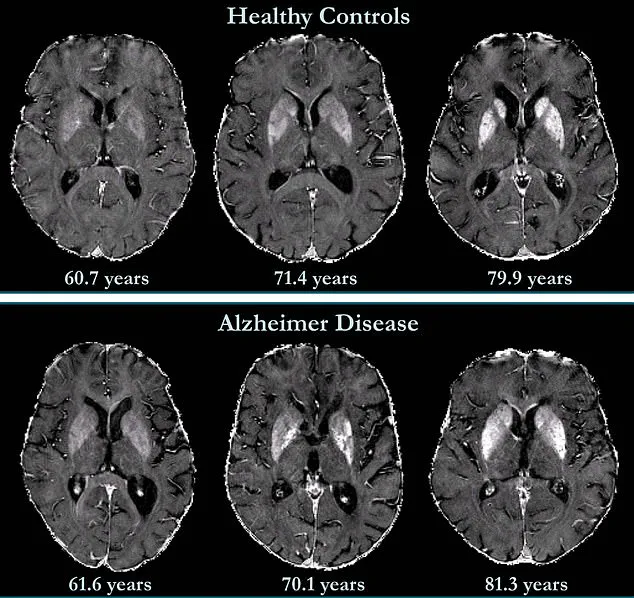 Late-Breaking Discovery: Johns Hopkins Reveals Early Dementia Prediction via Novel Brain Imaging Technique