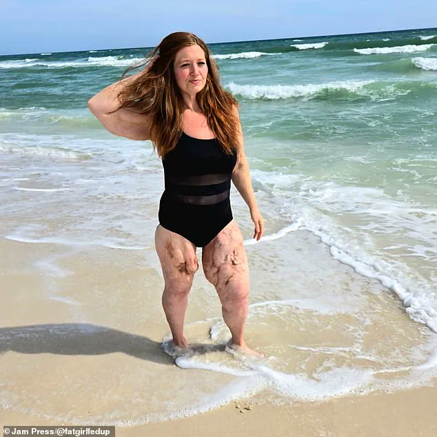 Exclusive Insights: Weight-Loss Medications and the Hidden Risk of Loose Skin