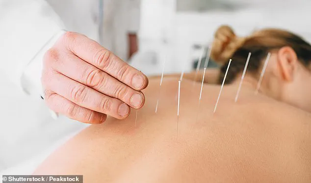 Study Suggests Acupuncture May Provide Long-Term Relief for Chronic Back Pain, According to JAMA Network Open Research
