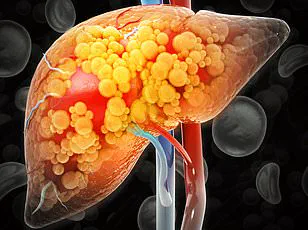 Silent Epidemic: Experts Warn of Hidden Fatty Liver Disease Crisis in the U.S.