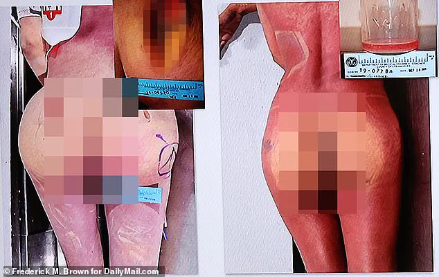 Conviction in Fatal Silicone Injection Case Sparks Industry-Wide Alarm Over Unregulated Beauty Procedures