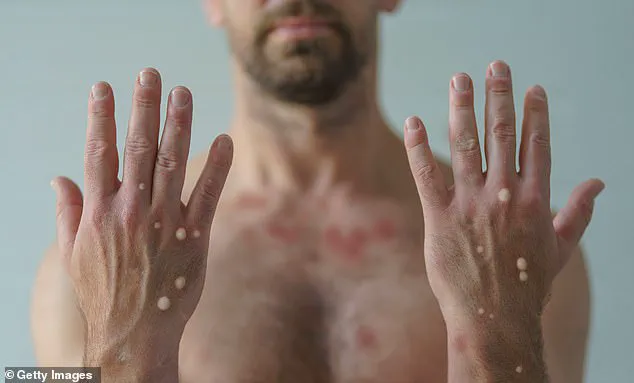 Exclusive: California Officials Confirm First Local Transmission of Deadlier Mpox Strain, Raising Alarms Over Hidden Outbreak Risks