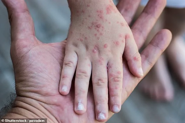 Unprecedented Surge in HFMD Sparks Urgent Warnings from Health Officials Across U.S. States