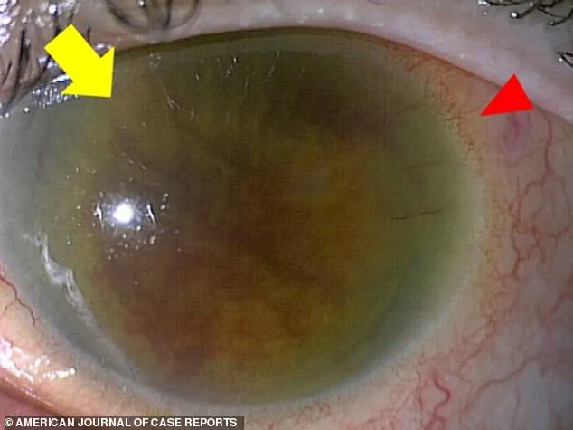 Medical Emergency: Harmless Skin Bacteria Now Causing Fatal Infections, Experts Warn