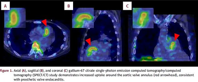 Medical Emergency: Harmless Skin Bacteria Now Causing Fatal Infections, Experts Warn