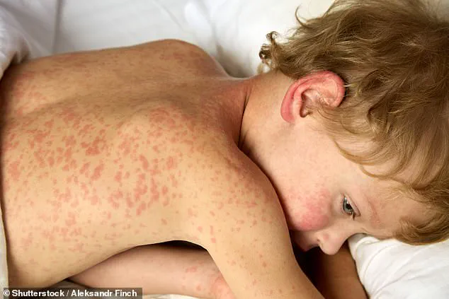 Public Health Alert: Measles Cases at Four Major U.S. Airports Raise Concerns During Holiday Travel