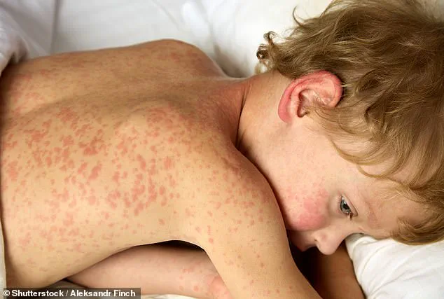 Measles Outbreak in South Carolina Surges to 434 Cases as Health Officials Issue Warnings