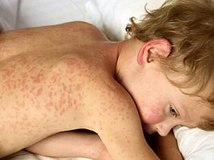 Measles Outbreak in South Carolina Surges to 434 Cases as Health Officials Issue Warnings