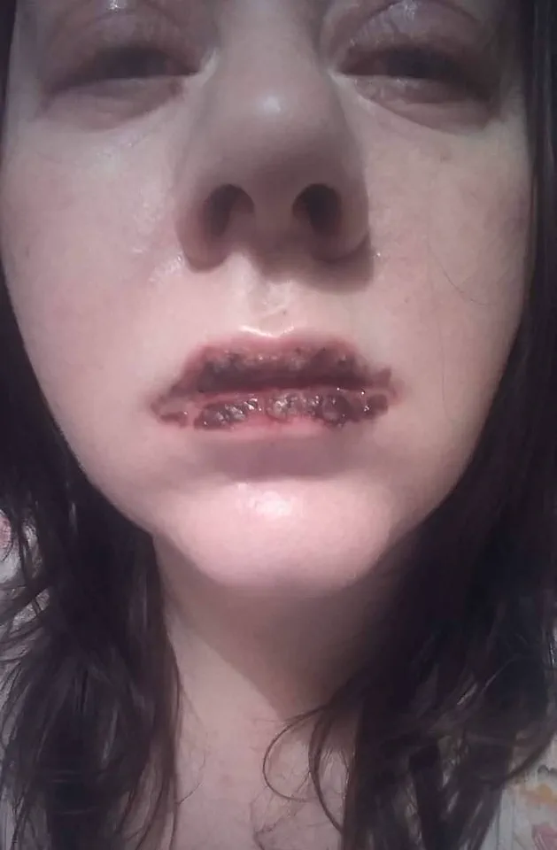 Urgent Health Alert: Benylin Use Triggers Harrowing Medical Emergency – What You Need to Know Now