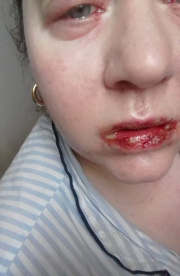 Urgent Health Alert: Benylin Use Triggers Harrowing Medical Emergency – What You Need to Know Now