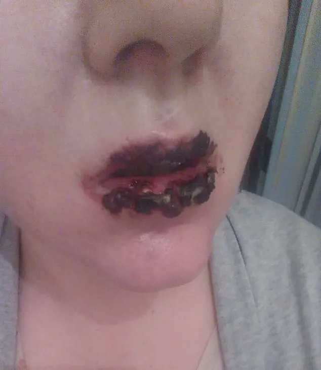 Urgent Health Alert: Benylin Use Triggers Harrowing Medical Emergency – What You Need to Know Now