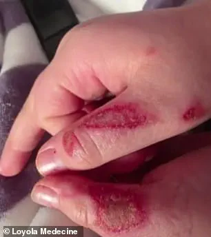 Nine-Year-Old Suffers Severe Burns After Microwaving Sensory Toy in Viral TikTok Challenge