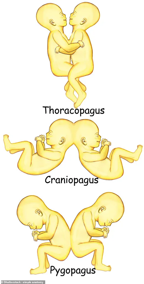 AI-Generated Conjoined Twins Go Viral, Raising Ethical Questions About Digital Commodification