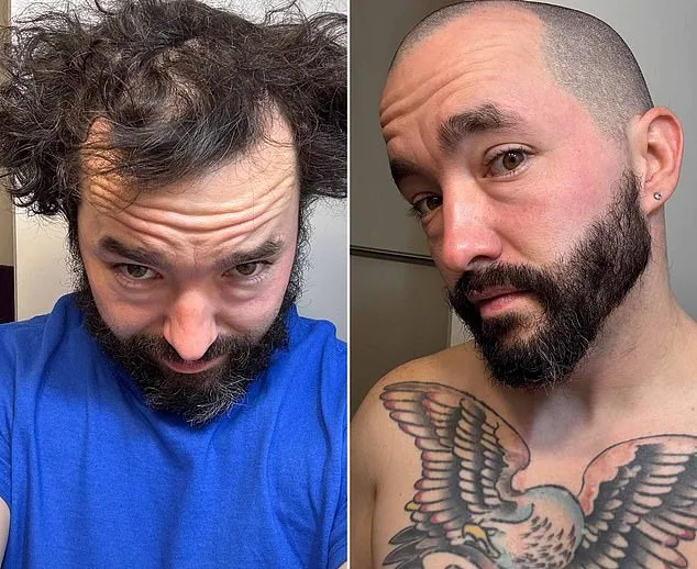 From Insecurity to Self-Acceptance: How r/bald Became a Supportive Community for Balding Men