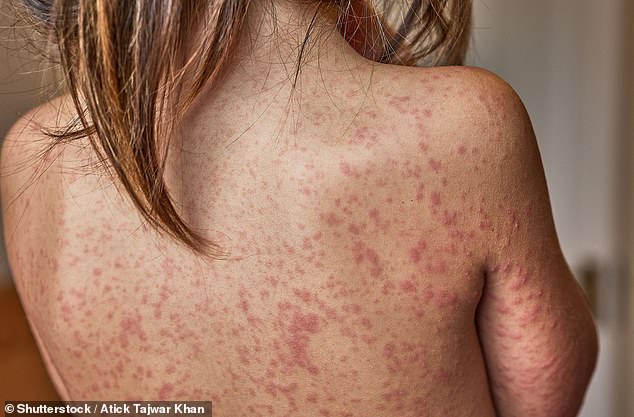 London on Brink of Measles Outbreak as Cases Surge Among Unvaccinated Children