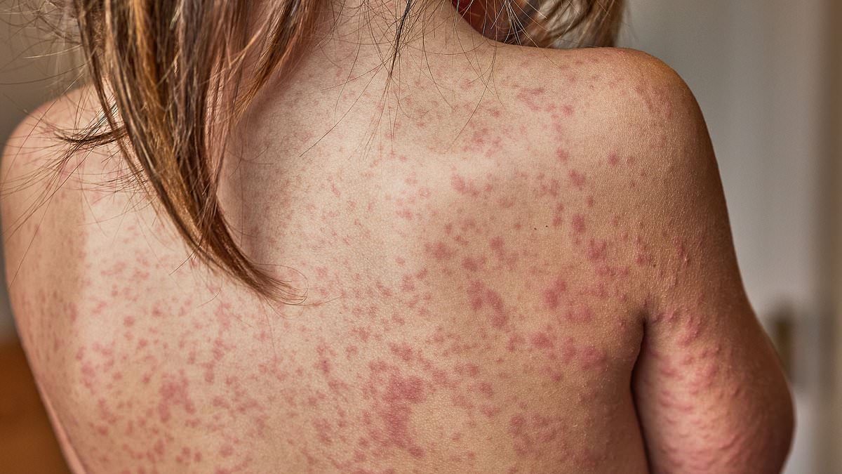 Measles Outbreak in London's Enfield Raises Alarms Amid Low Vaccination Rates