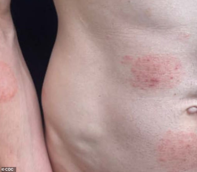 Minnesota's Largest Ringworm Outbreak: 40 Cases of Rare Fungal Infection TMVII Reported