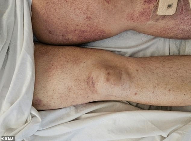 Scurvy Resurgence in the UK Linked to GLP-1 Weight Loss Drugs