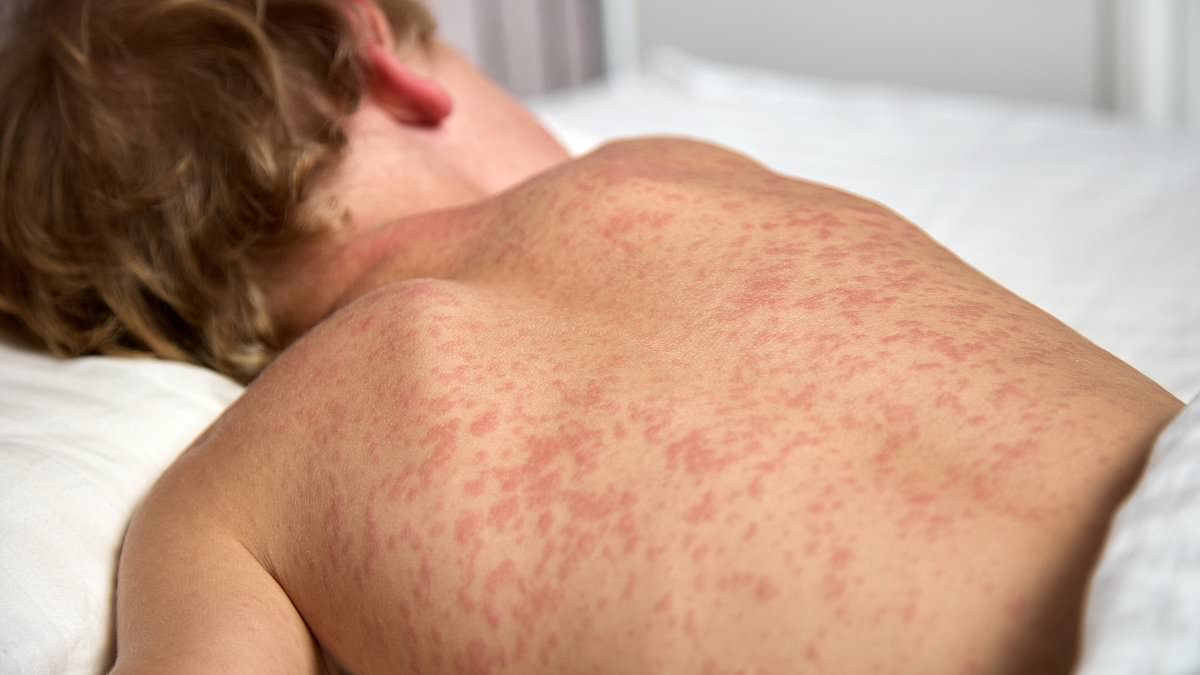 Utah High School Measles Outbreak Raises Alarms as 90% of Unvaccinated Students at Risk
