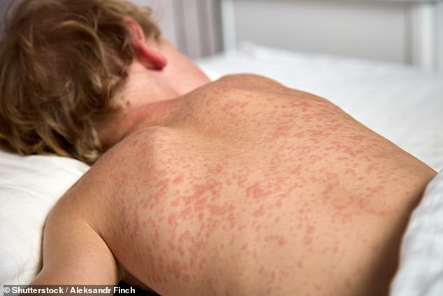 Utah High School Measles Outbreak Raises Alarms as 90% of Unvaccinated Students at Risk