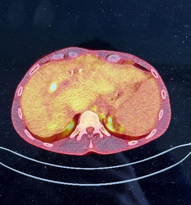 NHS Refuses Liver Transplant to Man with Rare Liver Cancer Over 4mm Tumor Size Limit