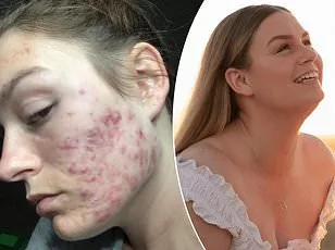 A Decade of Misdiagnosis: Olivia Ferro's Road to a PCOS Diagnosis