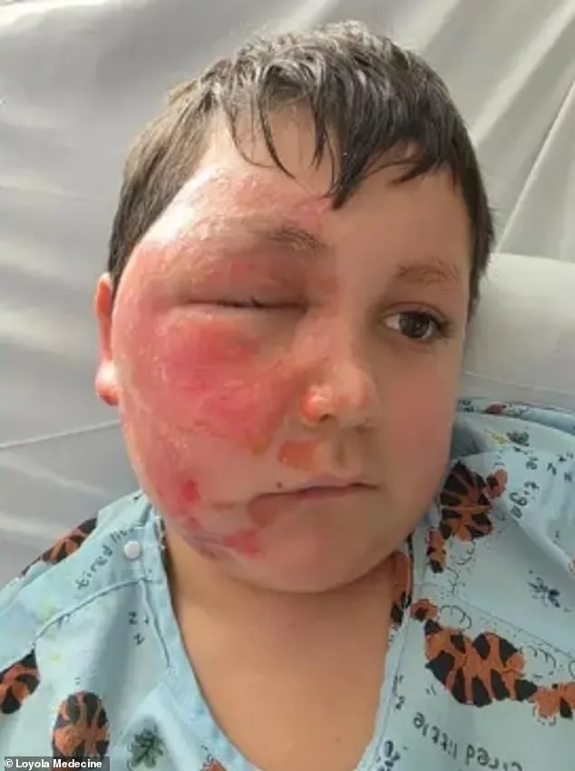 14-Year-Old Girl Hospitalized with Horrific Burns After Dangerous TikTok Fire Breathing Stunt in Pennsylvania