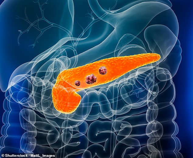 Early Warning Signal in Pre-Cancerous Cells Could Revolutionize Pancreatic Cancer Detection
