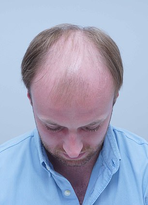 From Thinning Hair to Transformation: A Personal Journey Through Hair Loss and Self-Acceptance