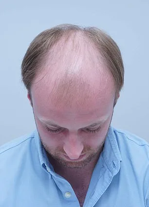 From Thinning Hair to Transformation: A Personal Journey Through Hair Loss and Self-Acceptance