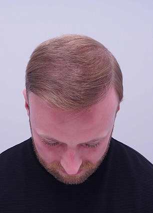 From Thinning Hair to Transformation: A Personal Journey Through Hair Loss and Self-Acceptance