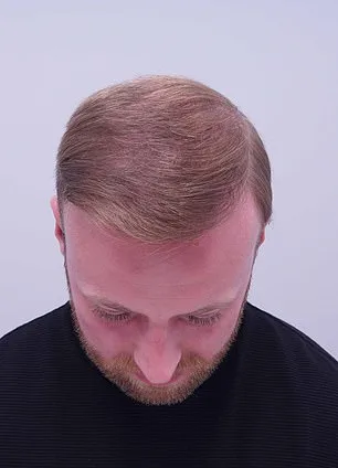 From Thinning Hair to Transformation: A Personal Journey Through Hair Loss and Self-Acceptance