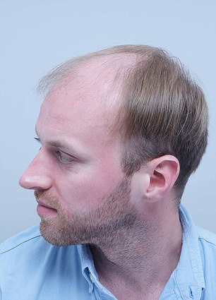 From Thinning Hair to Transformation: A Personal Journey Through Hair Loss and Self-Acceptance