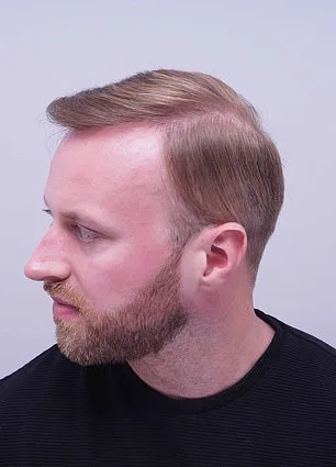 From Thinning Hair to Transformation: A Personal Journey Through Hair Loss and Self-Acceptance