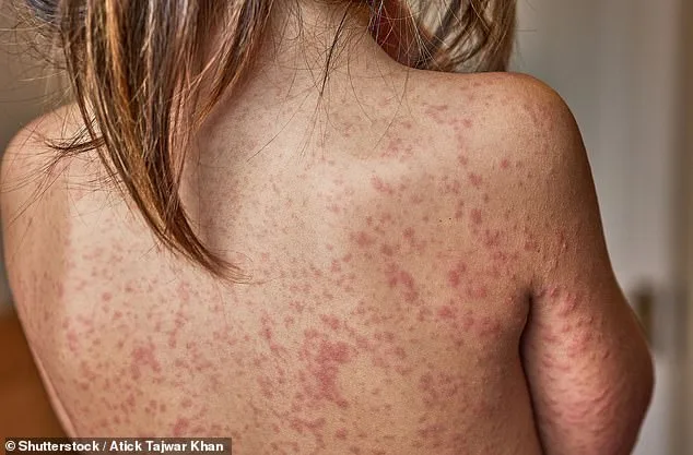 London Schools Consider Banning Unvaccinated Students as Measles Cases Surge