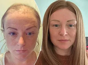 Grey Hair May Signal Early Melanoma Risk, Study Reveals