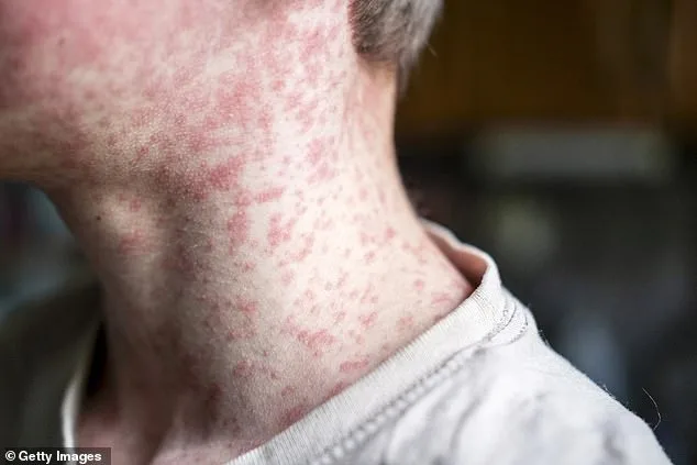 Measles Resurgence Sparks Fears of Deadly Complication: SSPE Linked to U.S. Outbreak