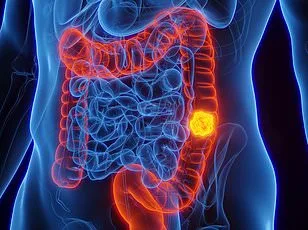 Hidden Warning Signs: Oral Changes Linked to Bowel Cancer Risk in the UK
