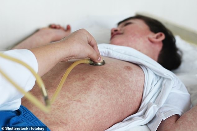 Measles Resurgence Sparks Health Crisis in 11 U.S. States Amid Vaccine Hesitancy