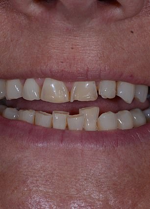 From Insecurity to Confidence: Mandy Turver's Smile Transformation