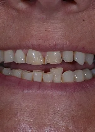 From Insecurity to Confidence: Mandy Turver's Smile Transformation