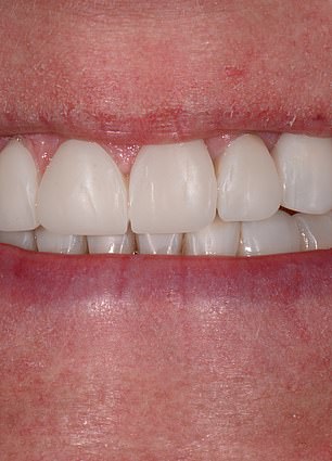 From Insecurity to Confidence: Mandy Turver's Smile Transformation