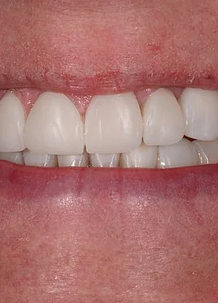 From Insecurity to Confidence: Mandy Turver's Smile Transformation