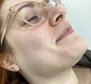 The Hidden Burden of Hirsutism: Georgia's Struggle with PCOS