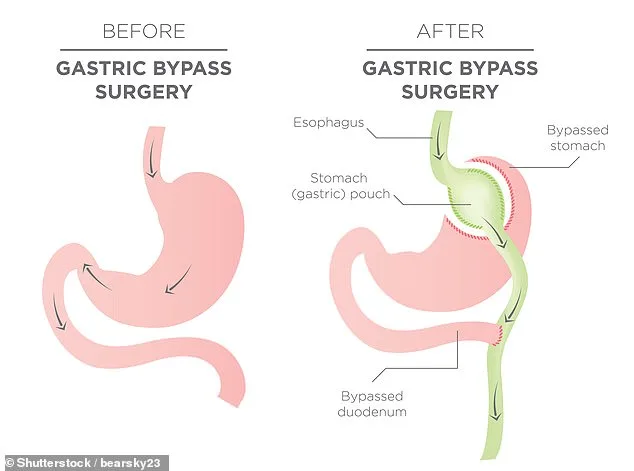 NHS Bariatric Surgeries Triple to 7,000 in 2024-25 as Obesity Crisis Intensifies